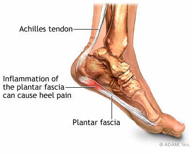 Plantar fasciitis holistic treatment shop